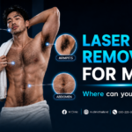 Laser Hair Removal for Men – Where Can You Treat? From the Chest and Armpits to Intimate Areas