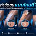 กำจัดขน แบบไหนดี เปรียบเทียบวิธีต่าง ๆ ที่ผู้ชายควรรู้ก่อนเลือก